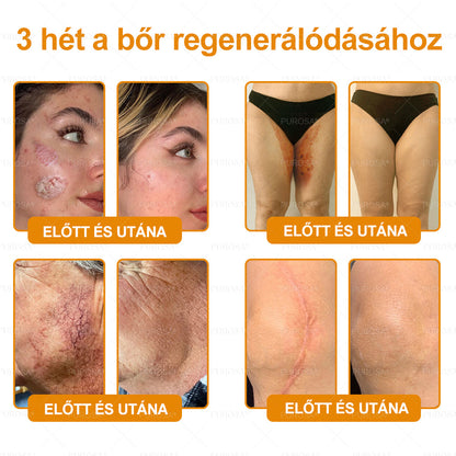 PUROSA® Méhméreges Bőrmegújító Krém 👑 Öregedésgátló, Hidratáló, Bőrregeneráló, Egységes Bőrtónus, Pattanás- és Pigmentfoltkezelés, Szemölcs- és Anyajegyeltávolítás, Pikkelysömör Enyhítés ✨