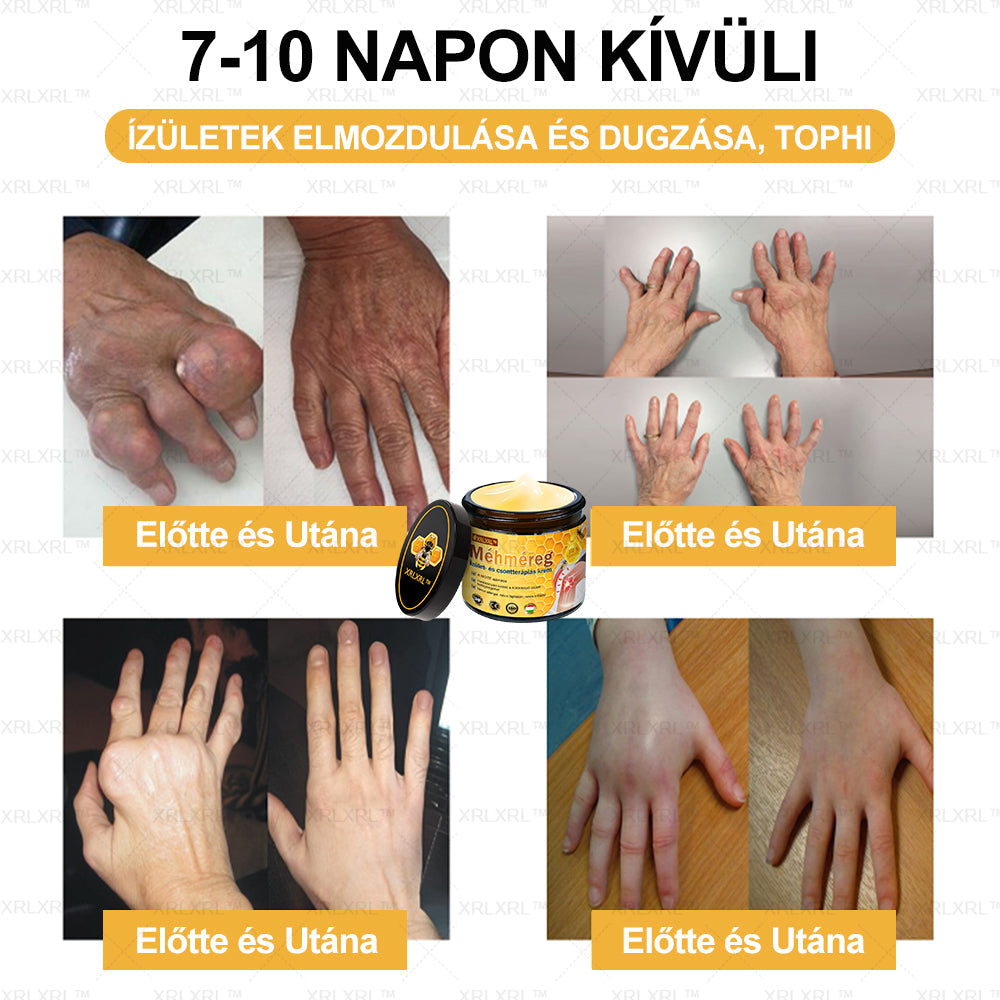 𝗫𝗥𝑳𝑿𝐑𝐋™ 𝗺é𝗵𝗺é𝐫𝐞𝐠 𝐟á𝗷𝗱𝗮𝗹𝗼𝒎𝒄𝒔𝒊𝒍𝒍𝒂𝒑í𝒕ó 𝗰𝘀𝗼𝗻𝘁𝗴𝒚ó𝐠𝐲í𝐭ó 𝐤𝐫é𝒎 (különösen alkalmas idősek számára, a Magyar Ortopédiai Társaság ajánlása alapján)