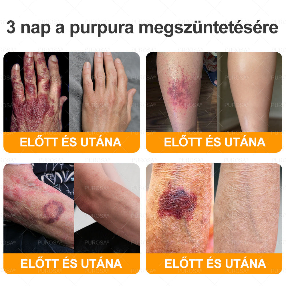 PUROSA® Méhméreges Bőrmegújító Krém 👑 Öregedésgátló, Hidratáló, Bőrregeneráló, Egységes Bőrtónus, Pattanás- és Pigmentfoltkezelés, Szemölcs- és Anyajegyeltávolítás, Pikkelysömör Enyhítés ✨