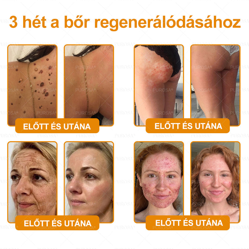 PUROSA® Méhméreges Bőrmegújító Krém 👑 Öregedésgátló, Hidratáló, Bőrregeneráló, Egységes Bőrtónus, Pattanás- és Pigmentfoltkezelés, Szemölcs- és Anyajegyeltávolítás, Pikkelysömör Enyhítés ✨