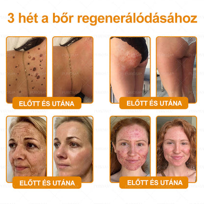 PUROSA® Méhméreges Bőrmegújító Krém 👑 Öregedésgátló, Hidratáló, Bőrregeneráló, Egységes Bőrtónus, Pattanás- és Pigmentfoltkezelés, Szemölcs- és Anyajegyeltávolítás, Pikkelysömör Enyhítés ✨